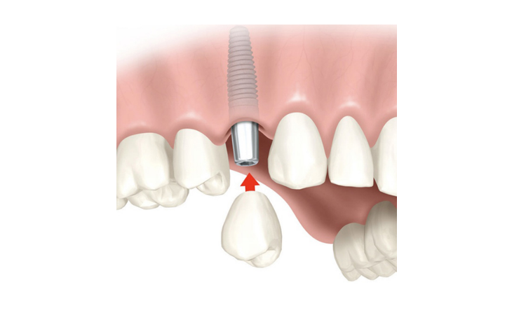 Conseils d'entretien en cas de chute du couvercle de l'implant dentaire | Le meilleur implant à Ispahan