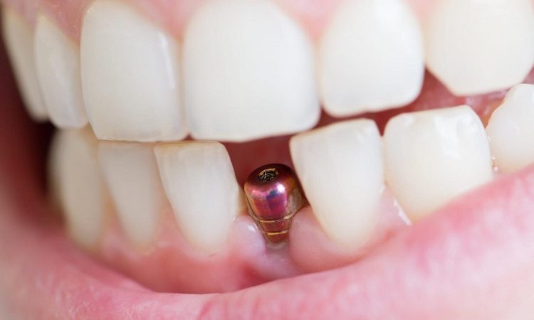نکاتی برای ایمپلنت دندان جلو | بهترین دندانپزشک اصفهان