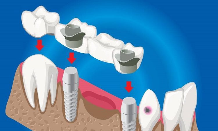 کاربردهای چسب موقت ایمپلنت دندان | بهترین جراح لثه اصفهان