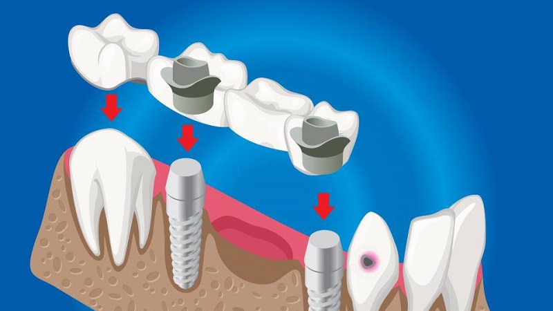 کاربردهای چسب موقت ایمپلنت دندان | بهترین جراح لثه اصفهان