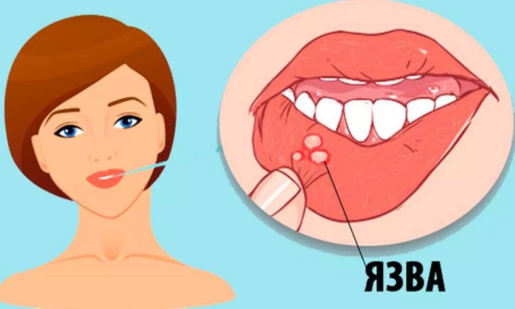 العلاجات المنزلية لتقرحات الفم | أفضل جراح لثة في اصفهان
