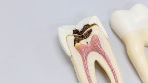 Treatment methods for tooth infection | The best dentist in Isfahan