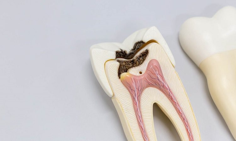 Méthodes de traitement de l'infection dentaire | Le meilleur dentiste d'Ispahan