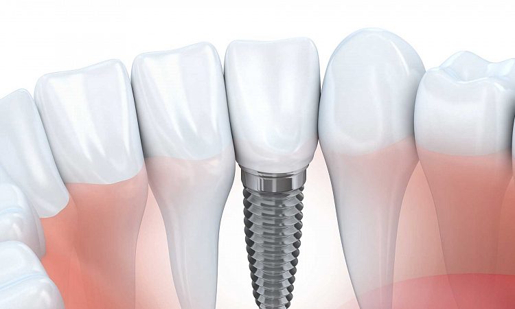 Familiarity with subprosthetal dental implant implantation | The best cosmetic dentist in Isfahan