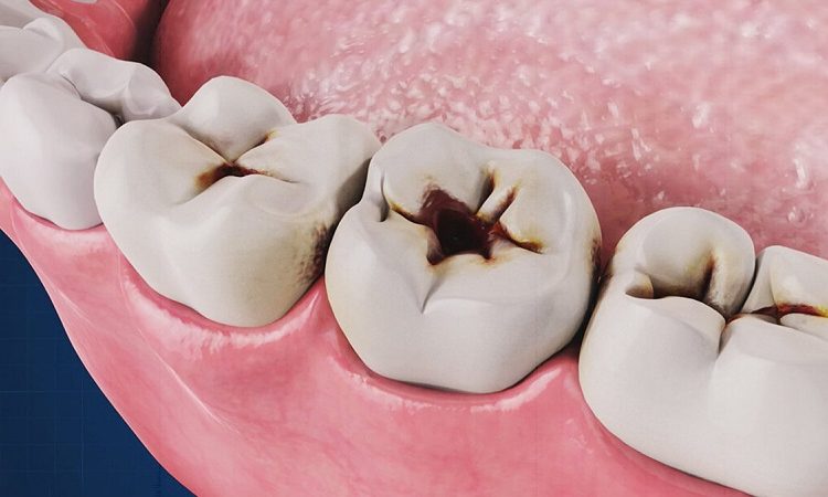 الاختلافات في تسوس الأسنان وتغير لونها | افضل دكتور اسنان في اصفهان
