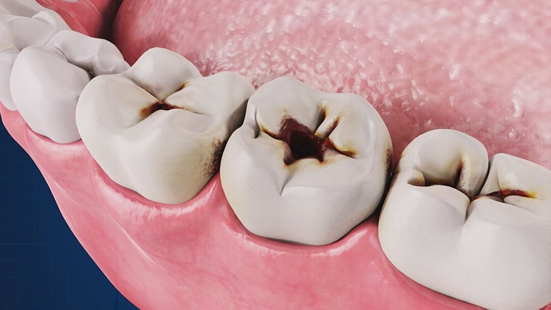 تفاوت های پوسیدگی و تغییر رنگ دندان | بهترین دندانپزشک اصفهان