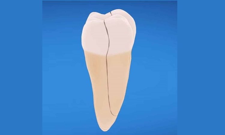 The risks and complications of leaving the root in the gum | The best gum surgeon in Isfahan