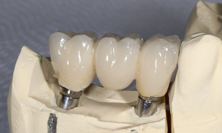 طرق تشكيل زراعة الأسنان | أفضل جراح لثة في اصفهان