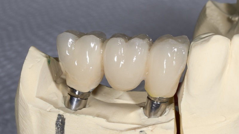 Méthodes de moulage d'implants dentaires | Le meilleur chirurgien des gencives à Ispahan