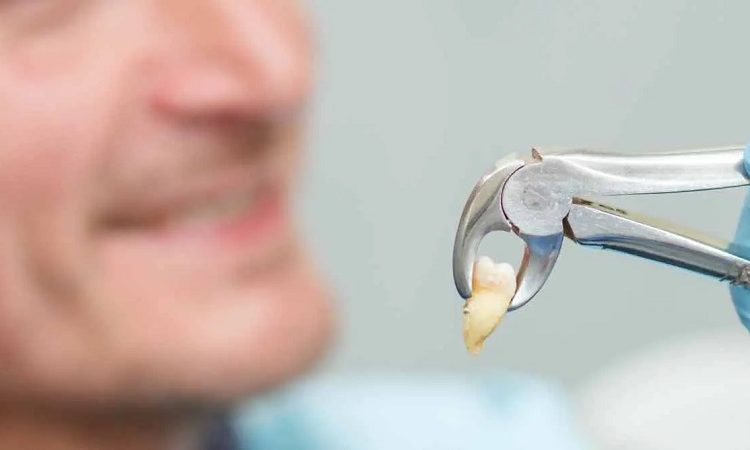 علائم زمان کشیدن دندان عقل | Le meilleur chirurgien des gencives à Ispahan