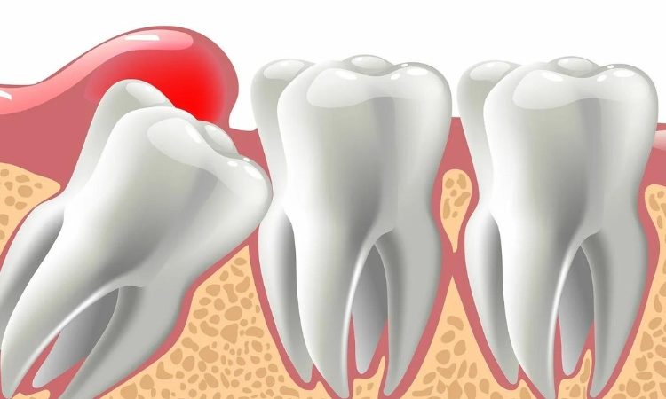 أسباب بقاء جذر الأسنان في اللثة | افضل دكتور اسنان في اصفهان