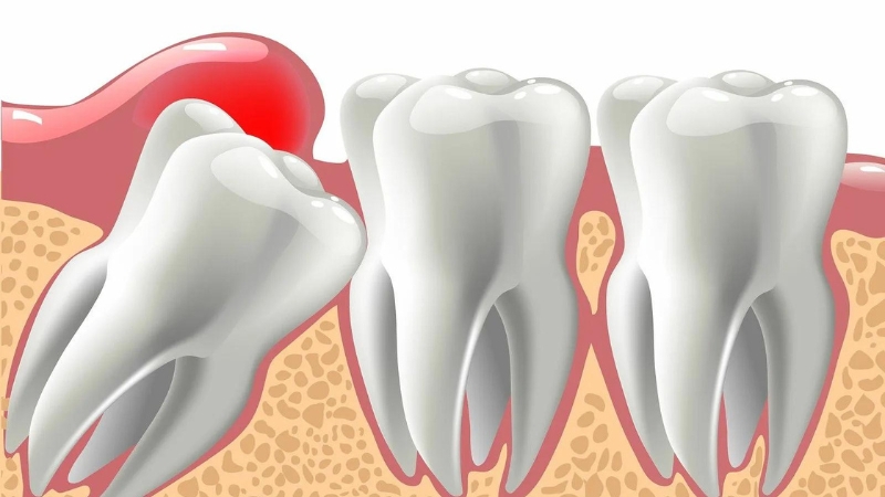 Causes of tooth root remaining in the gum | The best dentist in Isfahan