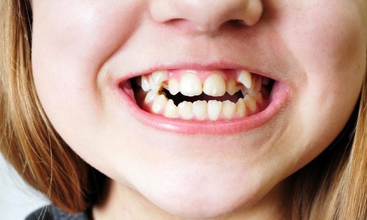 علل و درمان دندان کوسه ای در کودکان | بهترین ایمپلنت اصفهان