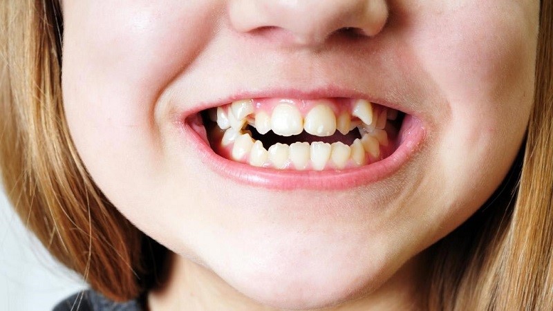علل و درمان دندان کوسه ای در کودکان | بهترین ایمپلنت اصفهان