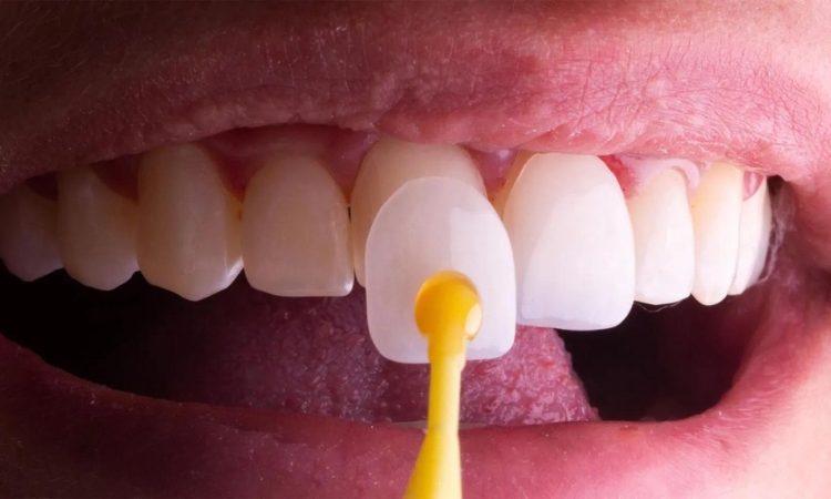 Conseils d'entretien après le changement du stratifié dentaire | Le meilleur dentiste d'Ispahan