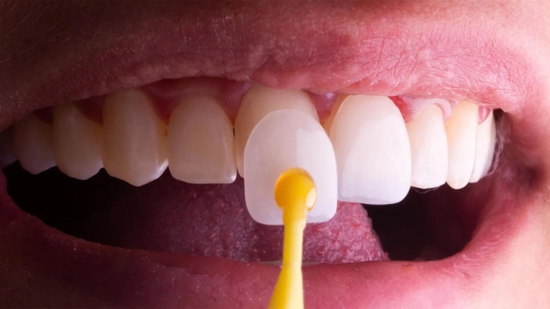 نکات مراقبتی پس از تعویض لمینت دندان | بهترین دندانپزشک اصفهان