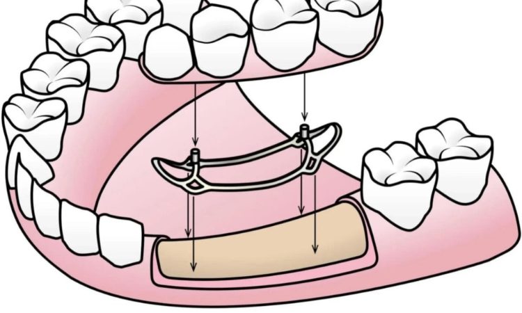 Tips for subprotestal implant implantation | The best dentist in Isfahan