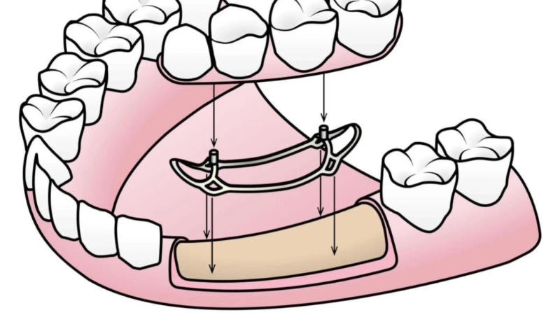 Tips for subprotestal implant implantation | The best dentist in Isfahan