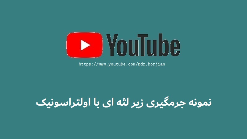 نمونه جرمگیری زیر لثه ای با اولتراسونیک