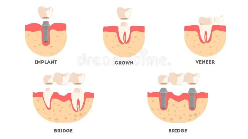 روش های بازسازی دندان | بهترین ایمپلنت اصفهان