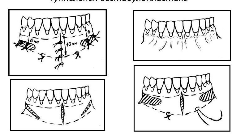 زراعة الأسنان وترقيع العظام بعد جراحة رأب الدهليز | افضل دكتور اسنان في اصفهان