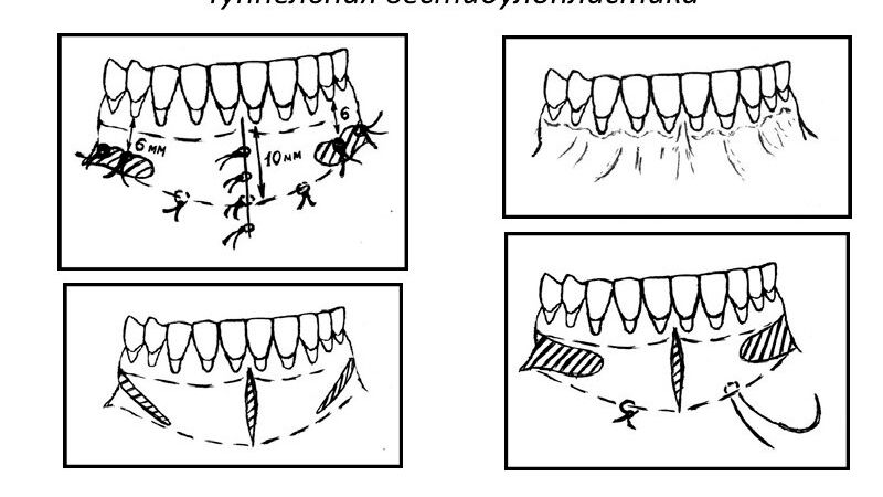 Dental implant and bone grafting after vestibuloplasty surgery | The best dentist in Isfahan