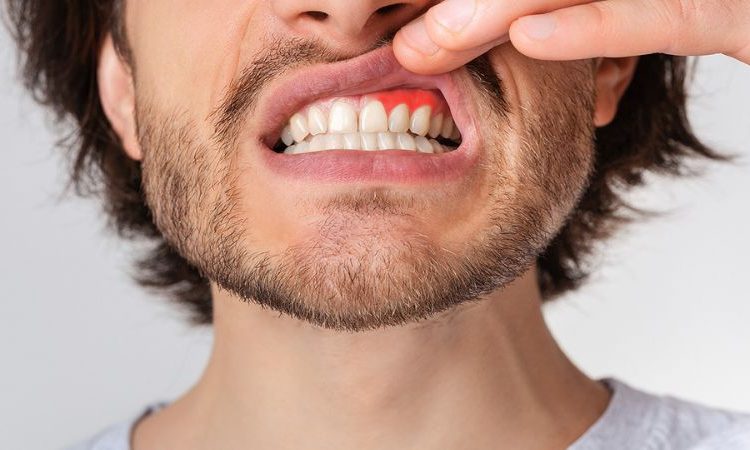 راه های کنترل کردن بیماری لثه | بهترین دندانپزشک اصفهان