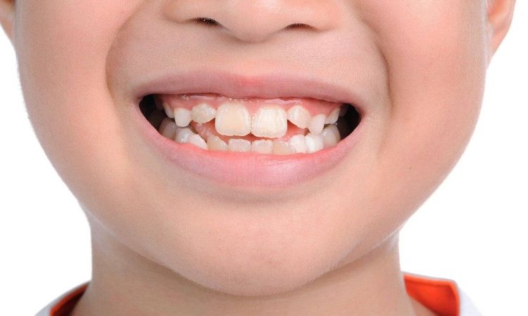 Causes of early growth of permanent teeth | The best implant in Isfahan