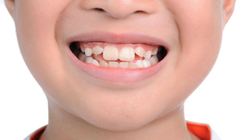 علل زود روییدن دندان های دائمی | بهترین ایمپلنت اصفهان