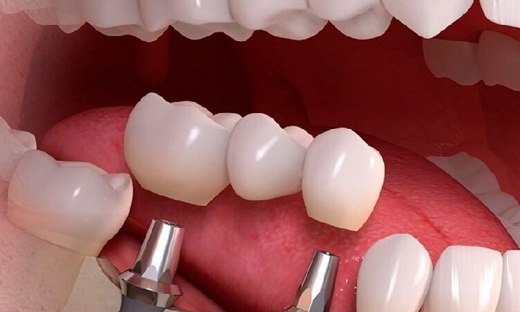 Dental implant molding steps in the open method | The best cosmetic dentist in Isfahan