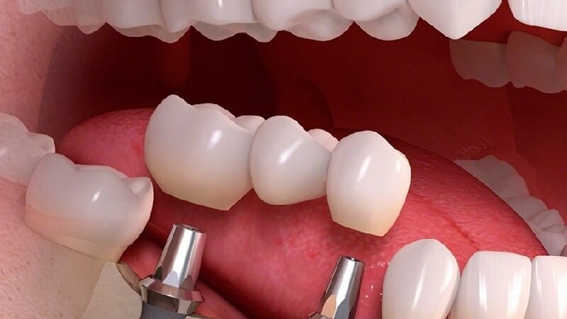 مراحل قالب گیری ایمپلنت دندان به روش باز | بهترین دندانپزشک زیبایی اصفهان