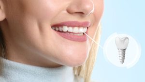 The advantages of implanting dental implants | The best dentist in Isfahan