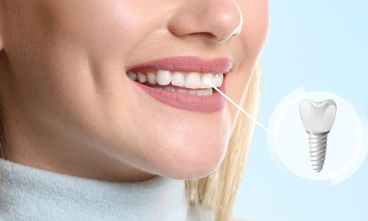مزايا زراعة الأسنان | افضل دكتور اسنان في اصفهان