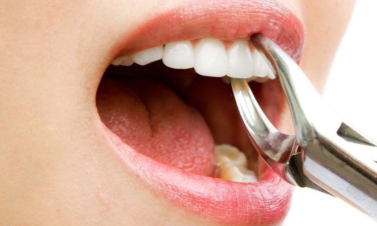 نکاتی برای انواع کشیدن دندان | بهترین جراح لثه اصفهان