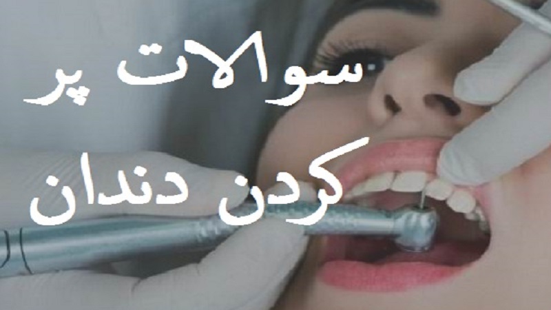 سوالات رایج پر کردن دندان ها (قسمت اول) | بهترین دندانپزشک اصفهان-بهترین جراح لثه اصفهان-بهترین دندانپزشک زیبایی اصفهان