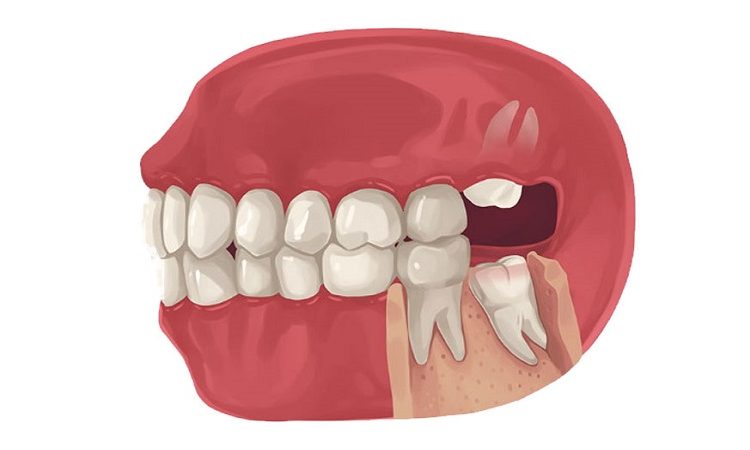 Wisdom tooth surgery | The best dentist in Isfahan - the best gum surgeon in Isfahan - the best cosmetic dentist in Isfahan