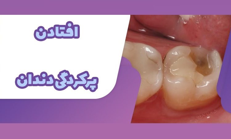 افتادن پرکردگی دندان | بهترین دندانپزشک اصفهان-بهترین جراح لثه اصفهان-بهترین دندانپزشک زیبایی اصفهان
