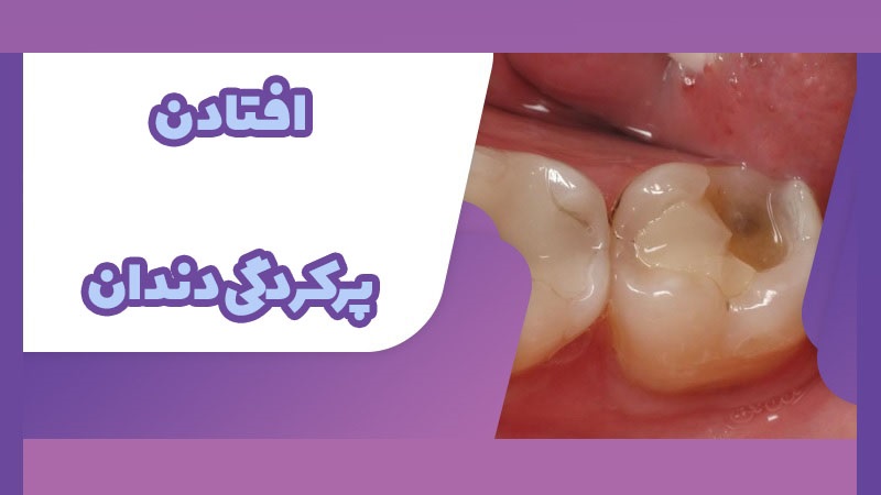 افتادن پرکردگی دندان | The best dentist in Isfahan - the best gum surgeon in Isfahan - the best cosmetic dentist in Isfahan