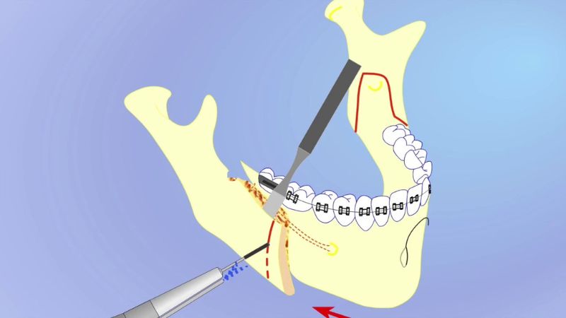 علل ضرورت وستیبولوپلاستی | The best gum surgeon in Isfahan