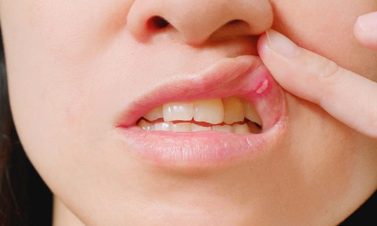 زخم های دهانی خطرناک | بهترین دندانپزشک اصفهان-بهترین جراح لثه اصفهان-بهترین دندانپزشک زیبایی اصفهان
