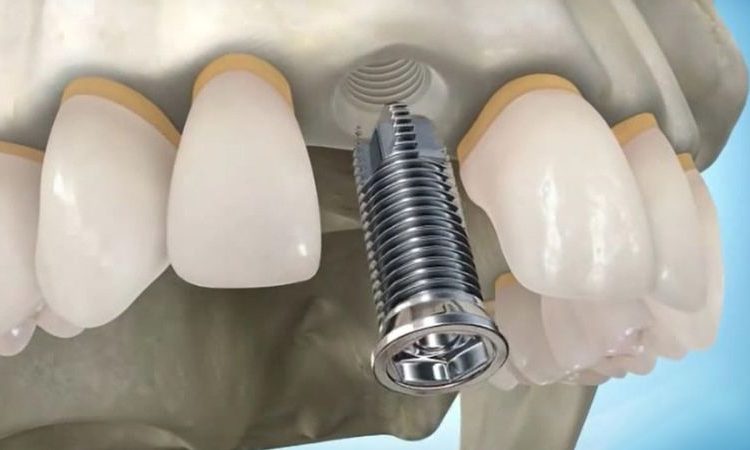 الفاصل الزمني لوضع الزرع بعد قلع الأسنان | افضل دكتور اسنان في اصفهان