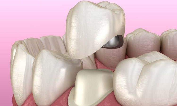 Le temps entre l’extraction nerveuse et les facettes dentaires | Le meilleur dentiste d'Ispahan