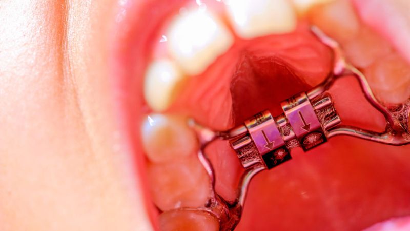 Quelques conseils sur l'utilisation d'un extenseur palatin | Le meilleur dentiste d'Ispahan