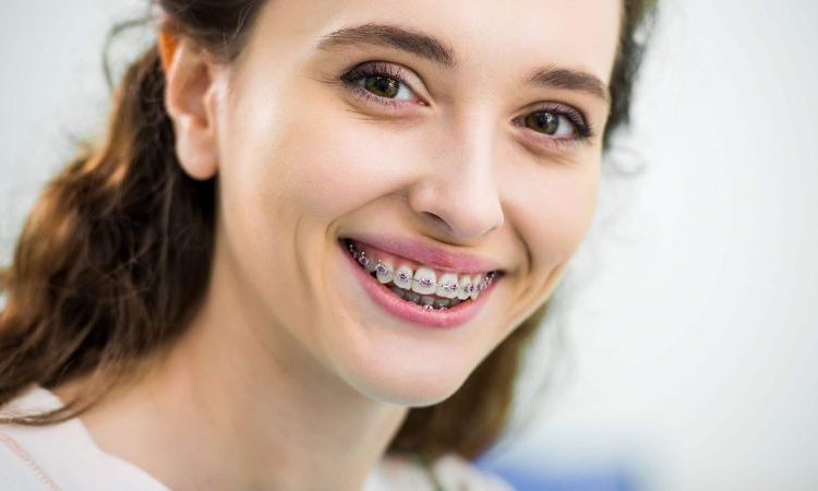 استخدام التقويم للأسنان الدائمة الملتوية أو المزدحمة | أفضل جراح لثة في اصفهان