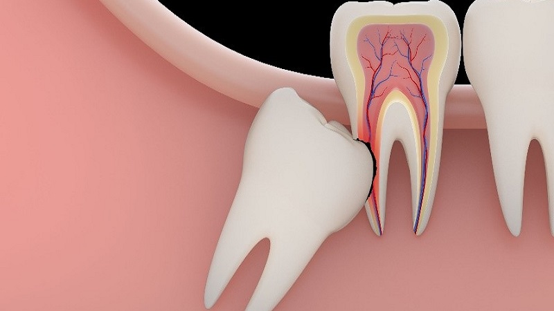 دلایل نهفته شدن دندان در زیر لثه | Le meilleur dentiste d'Ispahan - le meilleur chirurgien des gencives d'Ispahan - le meilleur dentiste cosmétique d'Ispahan