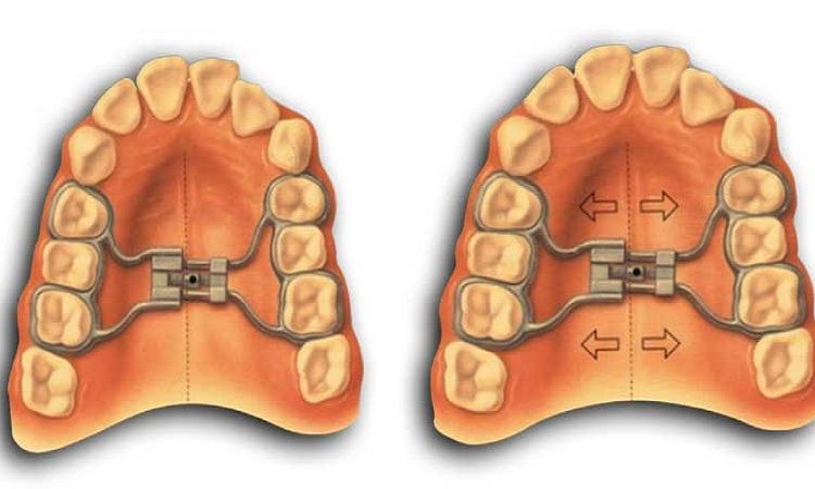 مزایا و معایب پالاتل اکسپندر | Le meilleur dentiste d'Ispahan - le meilleur chirurgien des gencives d'Ispahan - le meilleur dentiste cosmétique d'Ispahan