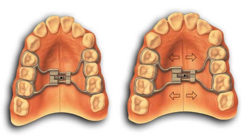 Advantages and disadvantages of palatal expander | The best dentist in Isfahan - the best gum surgeon in Isfahan - the best cosmetic dentist in Isfahan