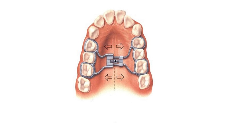 Comment fonctionne l'extenseur palatin | Le meilleur dentiste d'Ispahan - le meilleur chirurgien des gencives d'Ispahan - le meilleur dentiste cosmétique d'Ispahan