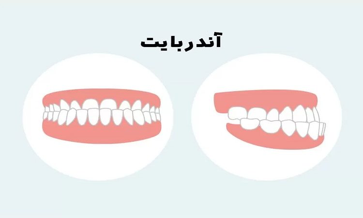 علت جلو بودن دندان و فک پایین | Le meilleur dentiste d'Ispahan - le meilleur chirurgien des gencives d'Ispahan - le meilleur dentiste cosmétique d'Ispahan