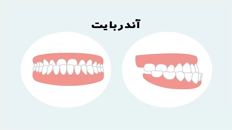 علت جلو بودن دندان و فک پایین | بهترین دندانپزشک اصفهان-بهترین جراح لثه اصفهان-بهترین دندانپزشک زیبایی اصفهان